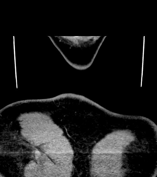 Branchial cleft cyst (Radiopaedia 31167-31875 Coronal C+ delayed 66).jpg