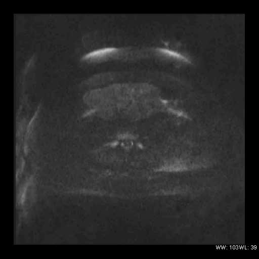 File:Broad ligament fibroid (Radiopaedia 49135-54241 Axial DWI 8).jpg