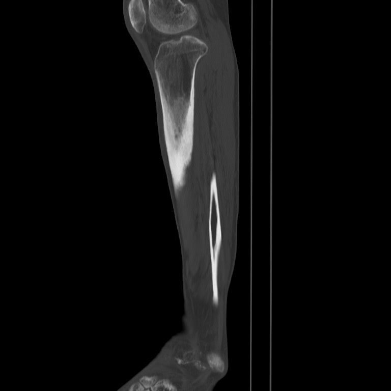 Brodie abscess - tibia (Radiopaedia 66028-75204 Sagittal bone window 51).jpg