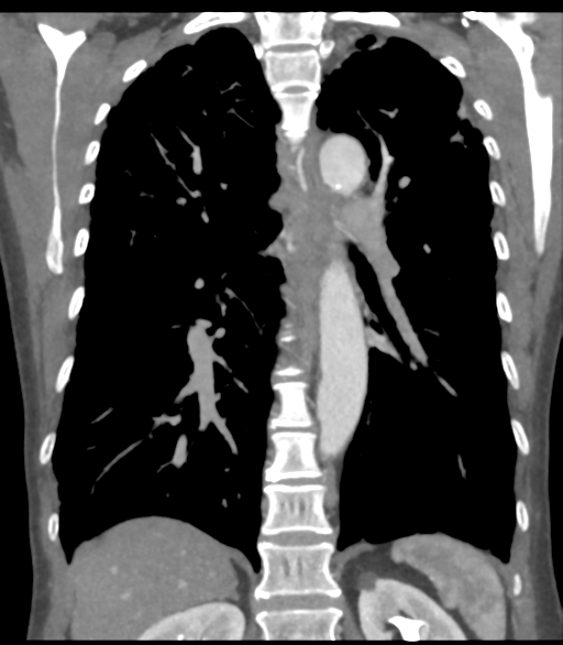Bronchial artery aneurysms (Radiopaedia 42282-45385 Coronal C+ delayed 43).png