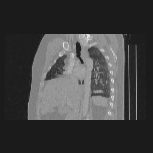 Bronchial atresia (Radiopaedia 60685-68439 Sagittal lung window 44).jpg