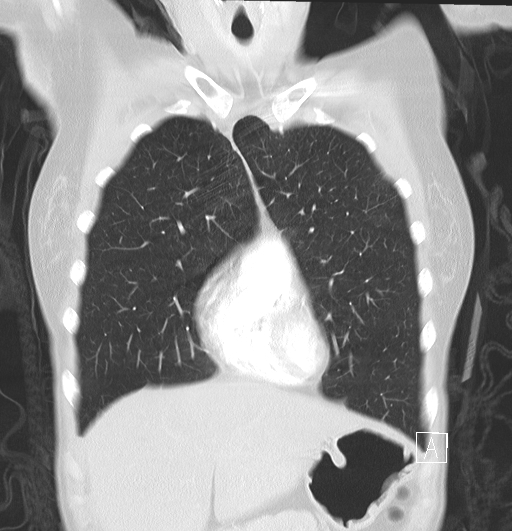 File:Bronchial atresia (Radiopaedia 73677-84470 Coronal lung window 8).jpg