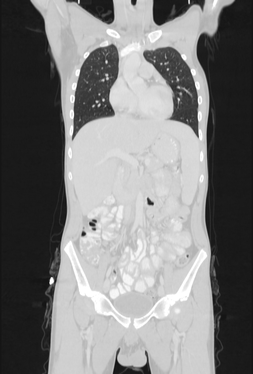 Bronchial carcinoid tumor (Radiopaedia 57187-64090 Coronal lung window 34).jpg