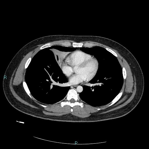 Bronchial carcinoid tumor (Radiopaedia 78272-90875 A 59).jpg