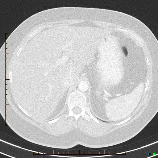 Bronchial diverticula (Radiopaedia 79512-92675 Axial lung window 48).jpg