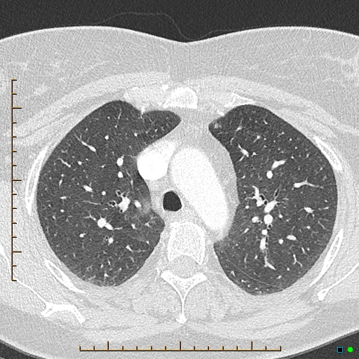 File:Bronchial diverticula (Radiopaedia 79512-92676 Axial lung window 51).jpg
