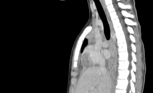 Bronchial mucoepidermoid carcinoma (Radiopaedia 57023-63895 Sagittal 104).jpg