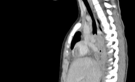 Bronchial mucoepidermoid carcinoma (Radiopaedia 57023-63895 Sagittal 97).jpg