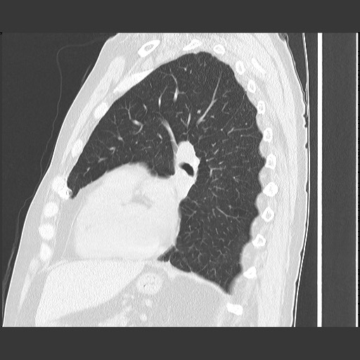 Bronchial stenosis - lung transplant (Radiopaedia 73133-83848 Sagittal lung window 44).jpg