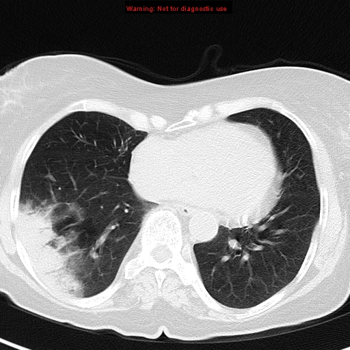 File:Bronchoalveolar carcinoma (BAC) (Radiopaedia 13436-13392 Axial lung window 34).jpg