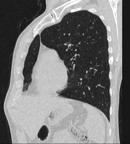 File:Bronchocele (Radiopaedia 60676-68429 Oblique lung window 1).jpg