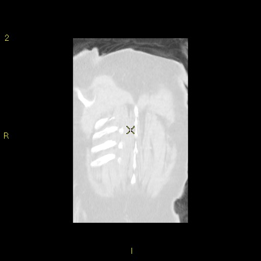 File:Bronchogenic carcinoma as an incidental finding (Radiopaedia 16453-16130 Coronal lung window 45).jpg