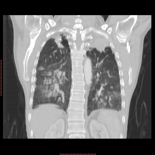 File:Bronchogenic carcinoma with left atrial large deposit - T4N3M1a (Radiopaedia 42316-45428 Coronal lung window 13).jpg