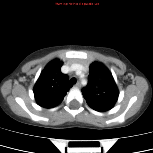 File:Bronchogenic cyst (Radiopaedia 9372-10063 C 3).jpg