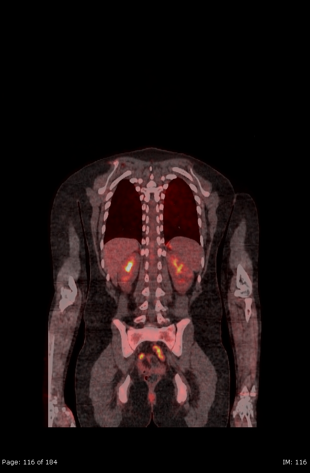 Brown fat uptake (FDG PET-CT) (Radiopaedia 77392-89513 Fused coronal 74).jpg
