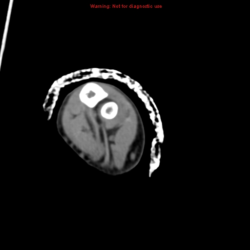 Brown tumor (Radiopaedia 12460-12694 Axial non-contrast 122).jpg