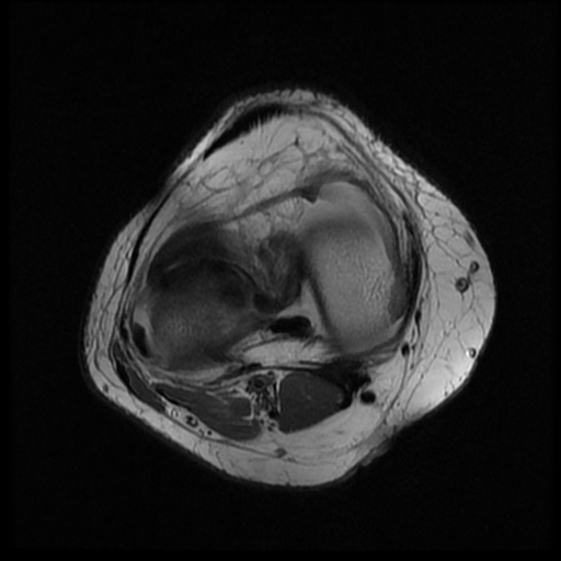 File:Bucket handle meniscus tear (Radiopaedia 56916-63751 Axial PD 12).jpg