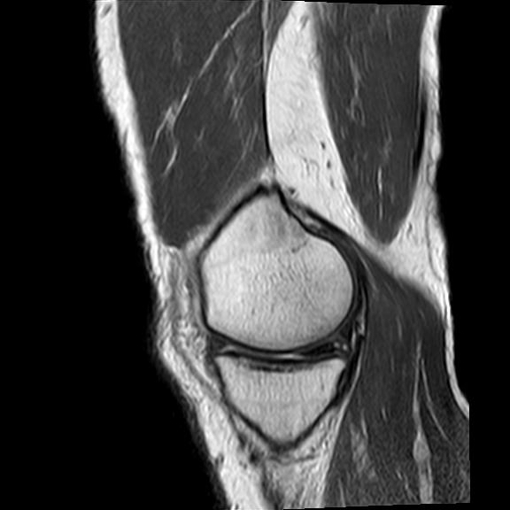 File:Bucket handle tear - medial meniscus (Radiopaedia 29250-29664 Sagittal PD 17).jpg