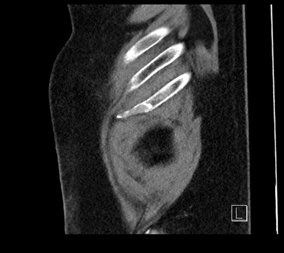 Buried bumper syndrome - gastrostomy tube (Radiopaedia 63843-72577 Sagittal Inject 6).jpg