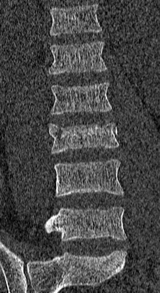 Burst fracture (Radiopaedia 53373-59357 Coronal bone window 28).jpg