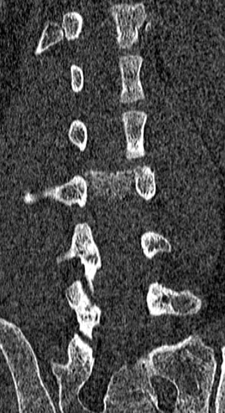Burst fracture (Radiopaedia 53373-59357 Coronal bone window 47).jpg