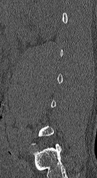 Burst fracture (Radiopaedia 53373-59357 Sagittal bone window 73).jpg