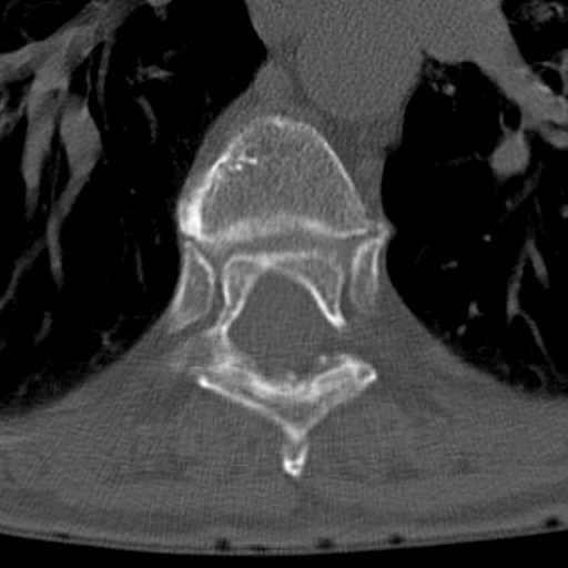 Butterfly vertebrae with kyphoscoliosis (Radiopaedia 14257-14133 Axial bone window 16).jpg
