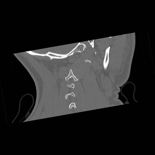 File:C1-C2 "subluxation" - normal cervical anatomy at maximum head rotation (Radiopaedia 42483-45607 Coronal non-contrast 51).jpg