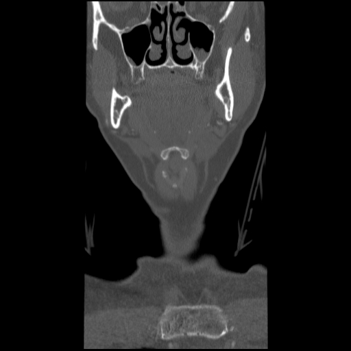 File:C1 anterior arch (plough) fracture - type 1 (Radiopaedia 76181-87720 Coronal bone window 91).jpg