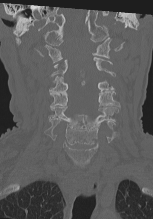 C2 fracture with vertebral artery dissection (Radiopaedia 37378-39199 Coronal bone window 18).png