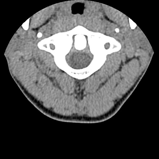 File:C5 facet fracture (Radiopaedia 58374-65499 Axial non-contrast 16).jpg