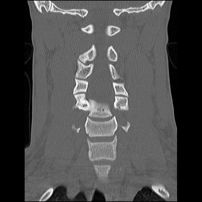 C5 facet fracture (Radiopaedia 58374-65499 Coronal bone window 32).jpg