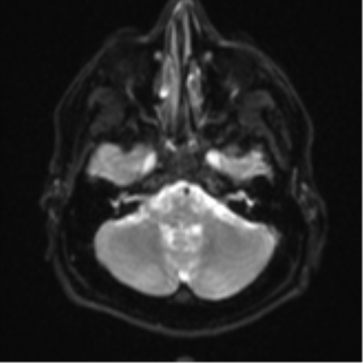 File:CNS vasculitis (Radiopaedia 55715-62263 Axial DWI 6).png