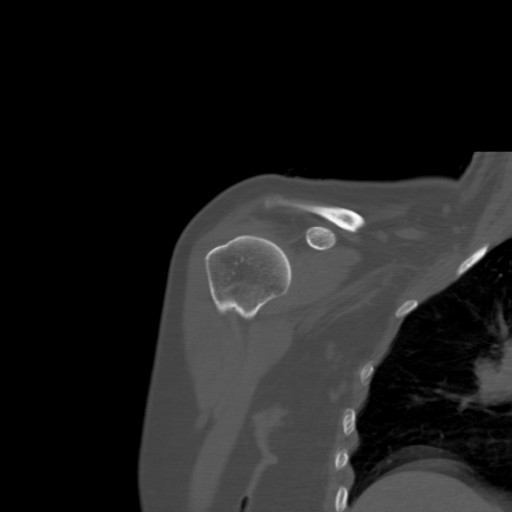 File:Calcific tendinitis of the infraspinatus tendon (Radiopaedia 87256-103539 Coronal bone window 20).jpg