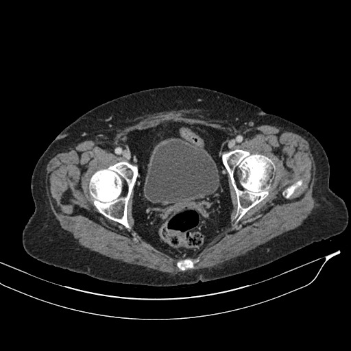 Calcified adrenal glands and Spigelian hernia (Radiopaedia 49741-54988 A 226).jpg