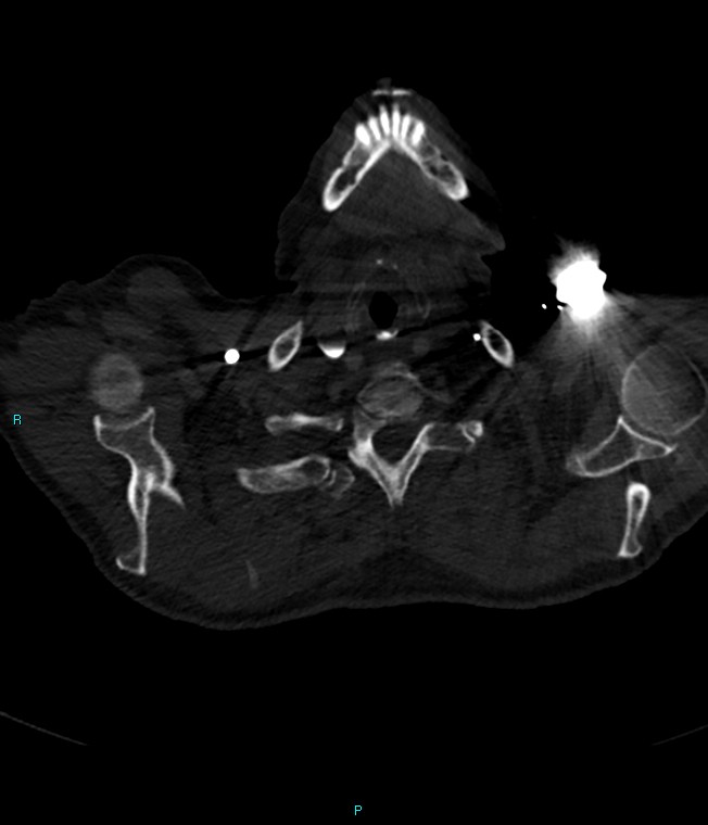 Calcified cerebral emboli from left ventricular thrombus (Radiopaedia 84420-99760 Axial bone window 2).jpg