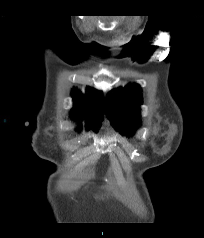 Calcified cerebral emboli from left ventricular thrombus (Radiopaedia 84420-99760 Coronal C+ CTPA 66).jpg