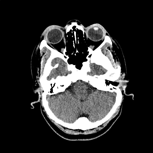 Calcified cerebral hydatid cyst (Radiopaedia 65603-74717 Axial non-contrast 8).jpg