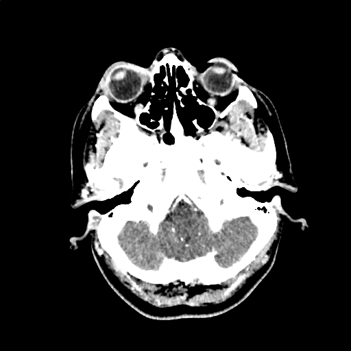 File:Calcified cerebral hydatid cyst (Radiopaedia 65603-74717 Axial with contrast 6).jpg