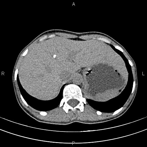 File:Calcified hepatic hydatid cyst (Radiopaedia 83870-99072 Axial non-contrast 33).jpg