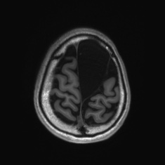 Callosal dysgenesis with interhemispheric cyst (Radiopaedia 53355-59335 Axial T1 135).jpg