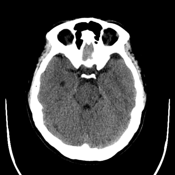 Calvarial osteoma (Radiopaedia 36520-38079 Axial non-contrast 19).jpg