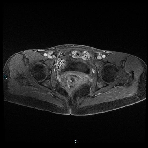File:Canal of Nuck cyst (Radiopaedia 55074-61448 Axial T1 C+ fat sat 39).jpg