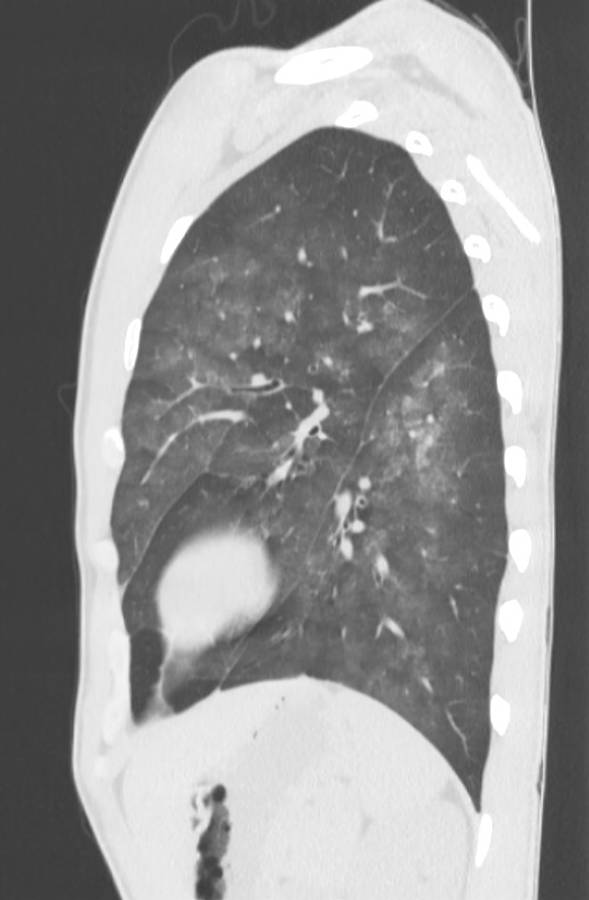 Cannabis-induced diffuse alveolar hemorrhage (Radiopaedia 89834-106946 Sagittal lung window 106).jpg
