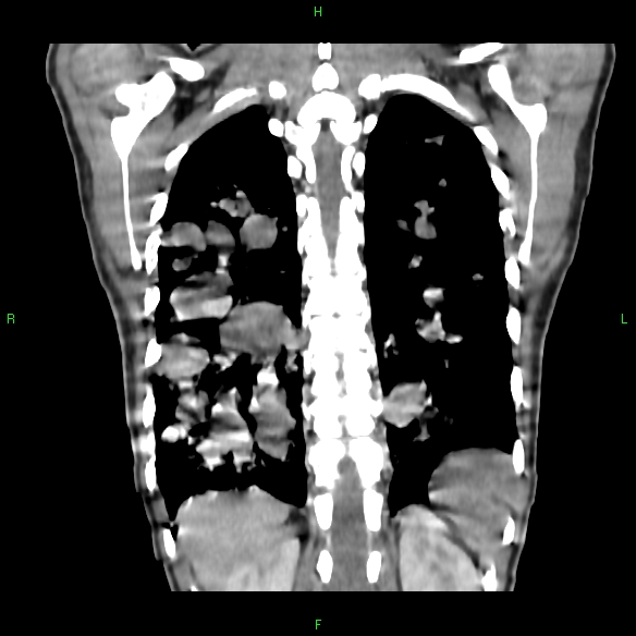 File:Cannon ball metastases - synovial sarcoma (Radiopaedia 26135-26271 Coronal liver window 17).jpg