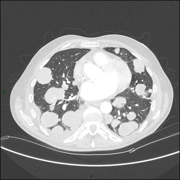 Cannonball metastases (Radiopaedia 82110-96150 Axial lung window 119).jpg