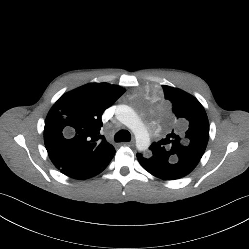 File:Cannonball metastases - testicular choriocarcinoma (Radiopaedia 84510-99891 B 45).jpg