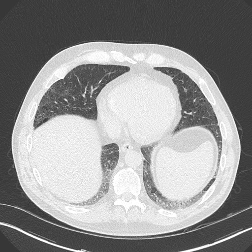 Caplan syndrome (Radiopaedia 56667-63530 Axial lung window 146).jpg