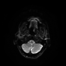 Carcinoma ex-pleomorphic adenoma of parotid (Radiopaedia 28383-28627 Ax DWI B-500 GE 21).jpg