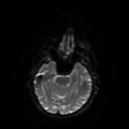 Carcinoma ex-pleomorphic adenoma of parotid (Radiopaedia 28383-28627 Ax DWI B-500 GE 29).jpg